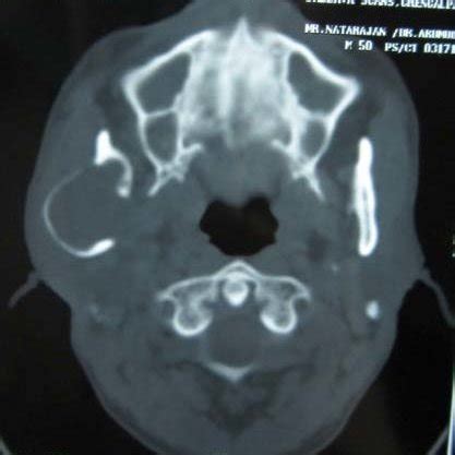 Opg Shows Multilocular Radiolucency Involving Right Mandibular Angle