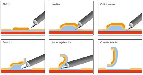 Endoscopic Submucosal Dissection Esd For Gastric Growths North Tees