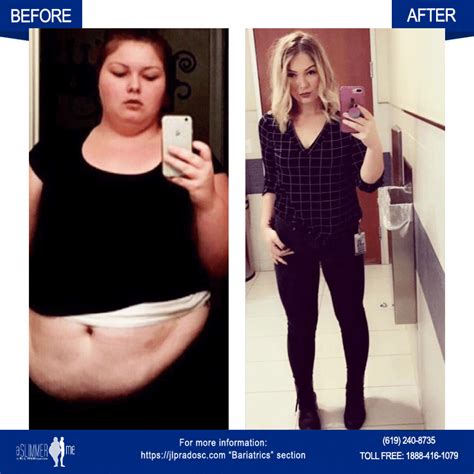 Before And After Bariatrics Jl Prado Surgical Center