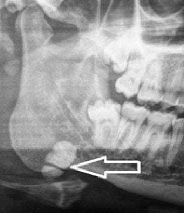 Panoramic Radiograph Cropped Presenting A Large Sialolith Arrow In