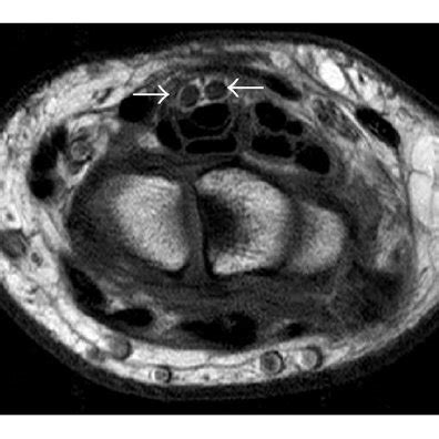 Intraoperative Photograph Presenting The Bifid Median Nerve Asterisks