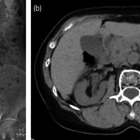 Intravenous Urography And CT Showing No Hydronephrosis At 14 Weeks And