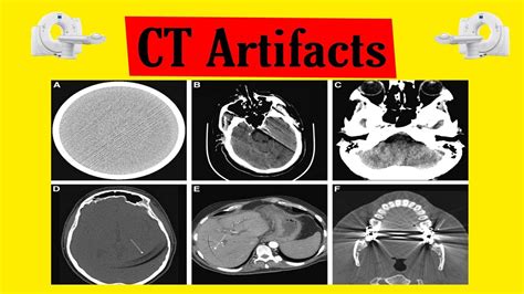 CT Artifacts In Hindi CT Image Artifacts Basics Of CT Radiology