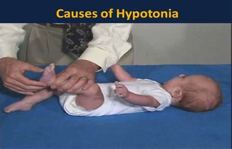 What Is Hypotonia? – Symptoms, Causes, Affected, and More