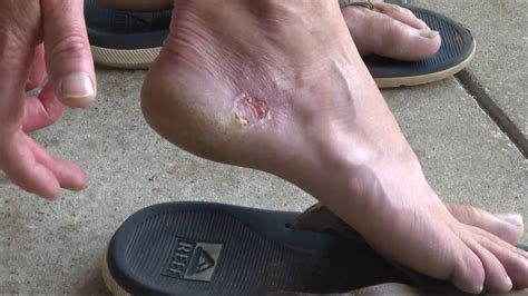 Man Contracted A Flesh Eating Bacteria After Walking On Lowcountry Beach