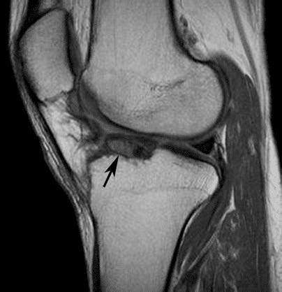 Running Solutions: My Patient Has A Cyclops Lesion!