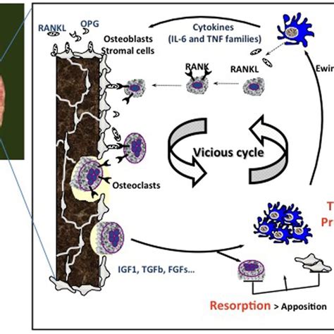 Vicious Cycle Between Ewing Sarcoma Cell Proliferation And Osteoclast