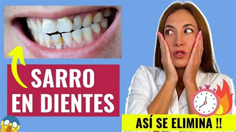 Sarro Dental C Mo Prevenirlo Ev Talo Con Estos Remedios Youtube