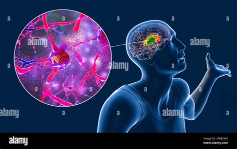 Striatum Dorsal Noyau Caud Et Putamen Mis En Vidence Dans Le