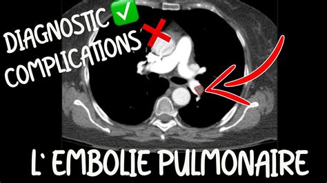 Radiologie L Embolie Pulmonaire Pour L Edn Bases Pour Tout M Decin