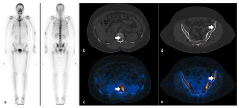 Cancers Free Full Text Quantitative Analysis Of Spect Ct Data In