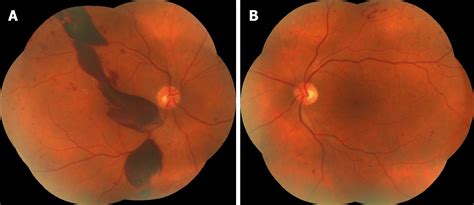 Snowflake Cataract Diabetes - DiabetesWalls