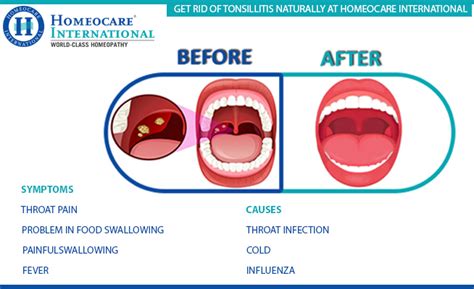 Homeocare International - Best Place for Tonsillitis Treatment ...