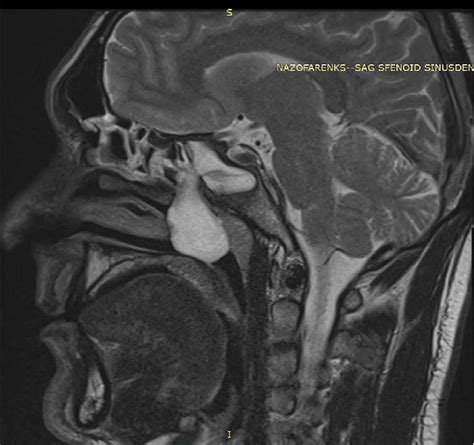 Nasal Polyp Mri