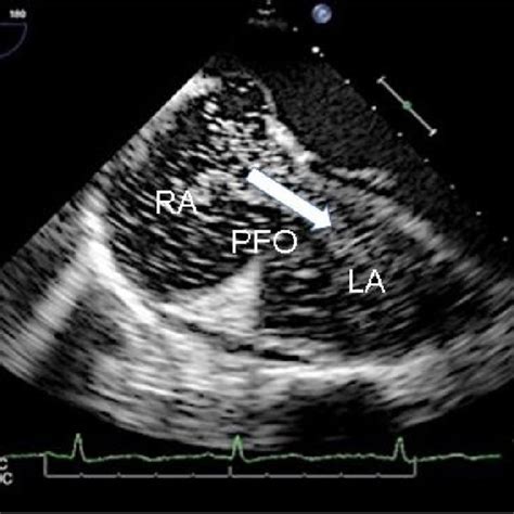 Acute left cerebellar stroke, hyper-dense lesion on T2 weighted MRI of... | Download Scientific ...