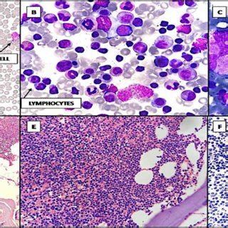 [A] Peripheral Smear (20x) showing absolute lymphocytosis with small ...