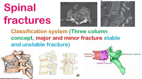 Spinal Fracture Classification System Three Column Concept Major