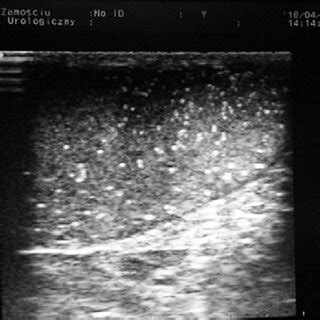 Ultrasonographic Image Of Testicular Microlithiasis Year Old