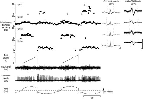 Typical Example Of Genioglossus Data With Four Motor Units Concurrently