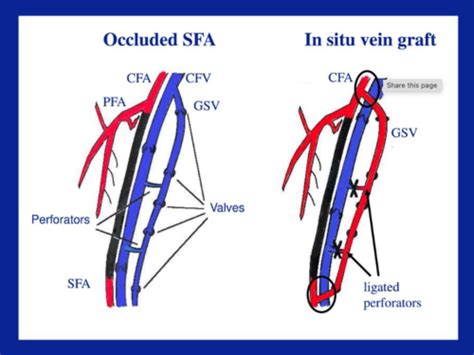 Bypass Grafts Flashcards Quizlet