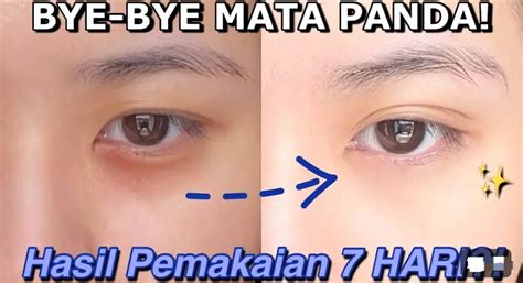 Kantung Mata Hilang Cara Menghilangkan Bawah Mata Hitam Pakai Bahan