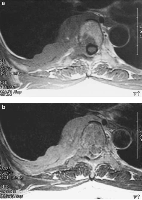 Primary Malignant Lymphoma In The Posterior Mediastinum Semantic Scholar