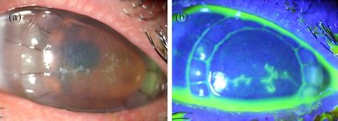 Recurrence Of Herpes Simplex Keratitis After Deep Anterior Lamellar Download Scientific Diagram