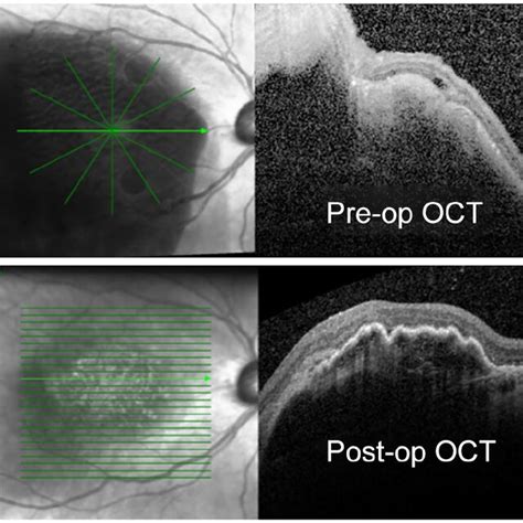 Preoperative And Postoperative Oct Images Of A Patient With Amd Who