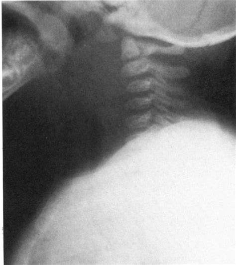 Mediastinal Bronchogenic Cyst Semantic Scholar