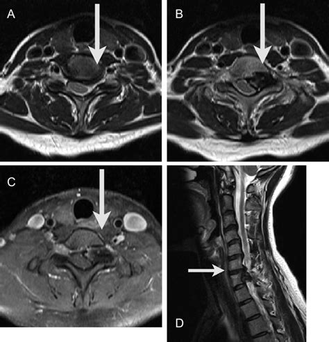 A Axial T2 Weighted Magnetic Resonance Imaging Mri Of The C67