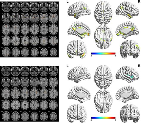 Frontiers Altered Functional Connectivity Within Default Mode Network