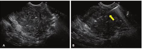 Endoscopic Ultrasound Eus A Hypoechoic Heterogeneous Mass With