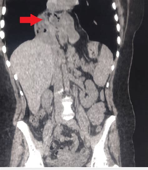 CT scan showing the paraesophageal hernia recurrence. Coronal scan ...