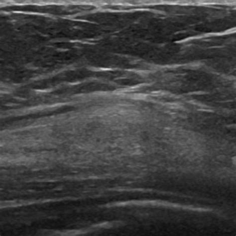 Ultrasound showing well-circumscribed hyperechoic mass (longitudinally ...