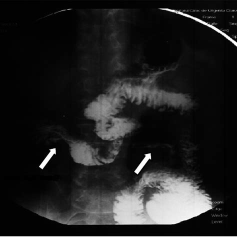 Barium meal X-ray, radiologic control at 2 years of follow-up The ...