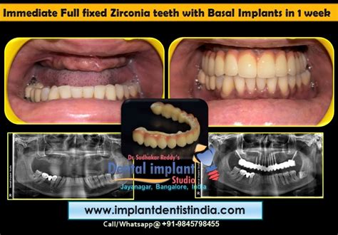 Full Arch Zirconia Teeth Bridge With Basal Implants Dental Implant