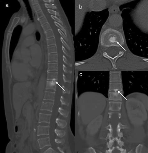 Acute Symptomatic Calcific Discitis In Adults A Case Report And Review Of Literature Springerlink