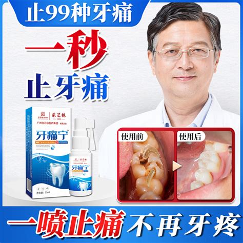 牙痛止疼效速牙疼牙龈脓包牙痛宁止疼喷雾剂疗治上火牙齿痛的药正虎窝淘