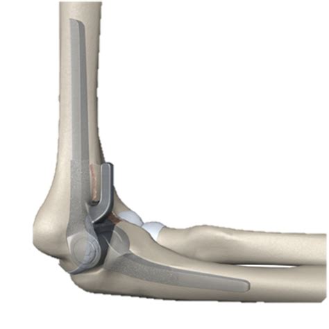 Reemplazo Total De Codo Prótesis De Codo Dr Salvador Arreola
