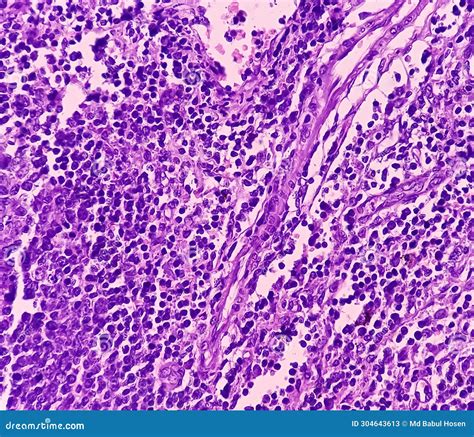 Thyroid Cancer Microscopic Image Of Metastatic Papillary Carcinoma Of