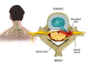 Cervical Radiculopathy Pinched Nerve In Neck Symptoms Off