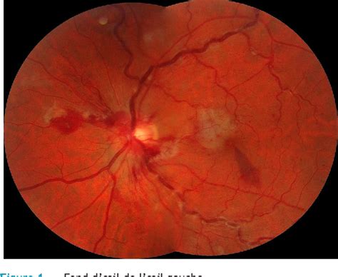 Figure 1 from Occlusion mixte de lartère cilio rétinienne et de la