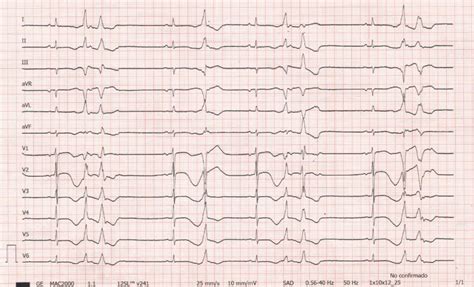 Asociaci N Cardiolog A Cl Nica Sec On Twitter Rt Fortunyelena