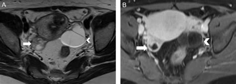 Magnetic Resonance Imaging In Tubal And Non Tubal Ectopic Pregnancy