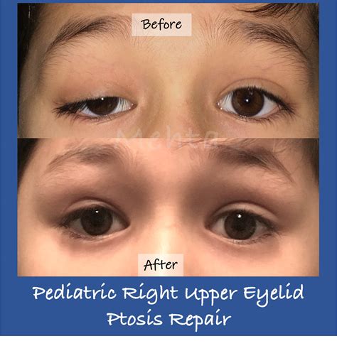 Ptosis Surgery Dc How To Fix Droopy Eyelids Washington Eye