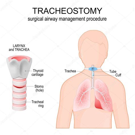 Traqueostom A Procedimiento Quir Rgico De Manejo De La V A A Rea