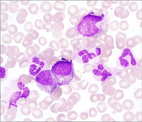 Chronic Myeloproliferative Disorders Flashcards Quizlet