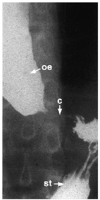 Barium Swallow Of The Oesophagus In A Triple A Patient With Achalasia