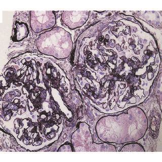 Light Microscopy Findings In The Renal Biopsy Specimen Glomeruli