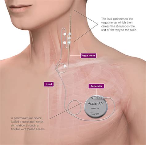 Vagus Nerve Stimulation Side Effects